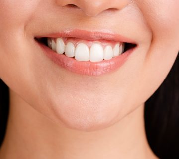 بلیچینگ دندان یا سفید کردن دندان